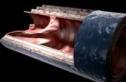 Биоинженерные сосуды как новая надежда для пациентов, не имеющих новых вен для операции коронарного шунтирования или диализа Биоинженерные сосуды как новая надежда для пациентов, не имеющих новых вен для операции коронарного шунтирования или диализа
