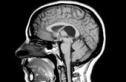 Сепсис и сопутствующие расстройства сердечного ритма могут вызвать инсульт