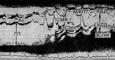 М-эхокардиограмма больной 5 лет с врожденной митральной недостаточностью М-эхокардиограмма больной 5 лет с врожденной митральной недостаточностью